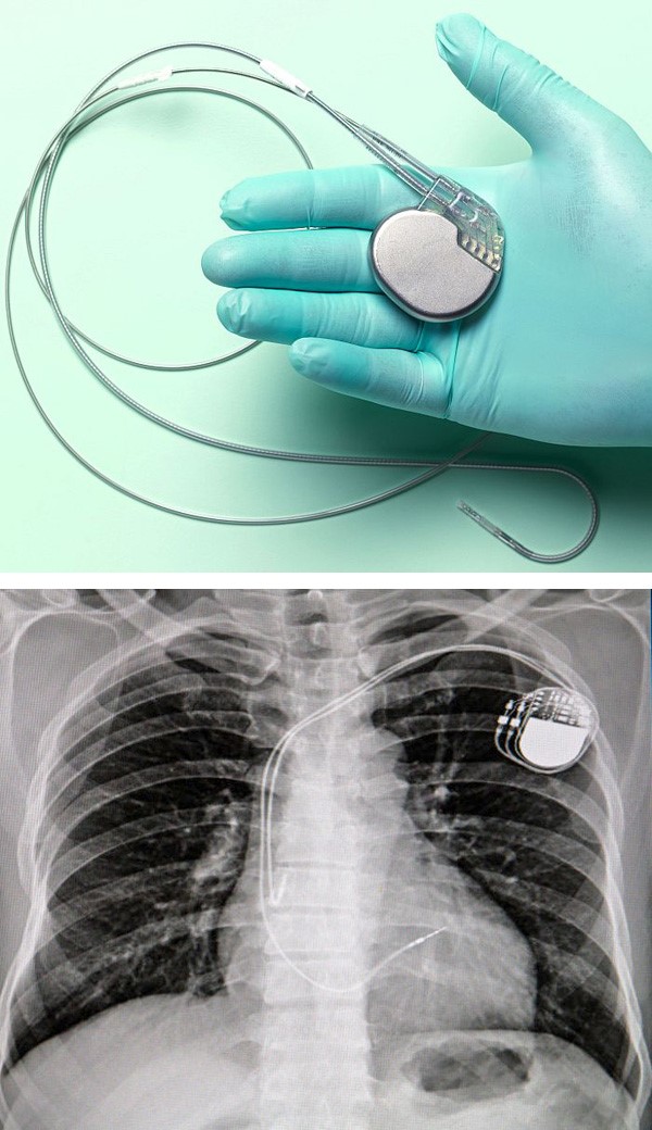 Ultrazvučni punjač baterija za pacemakere i defibrilatore implantirane u  pacijenta - Znanost @ Bug.hr